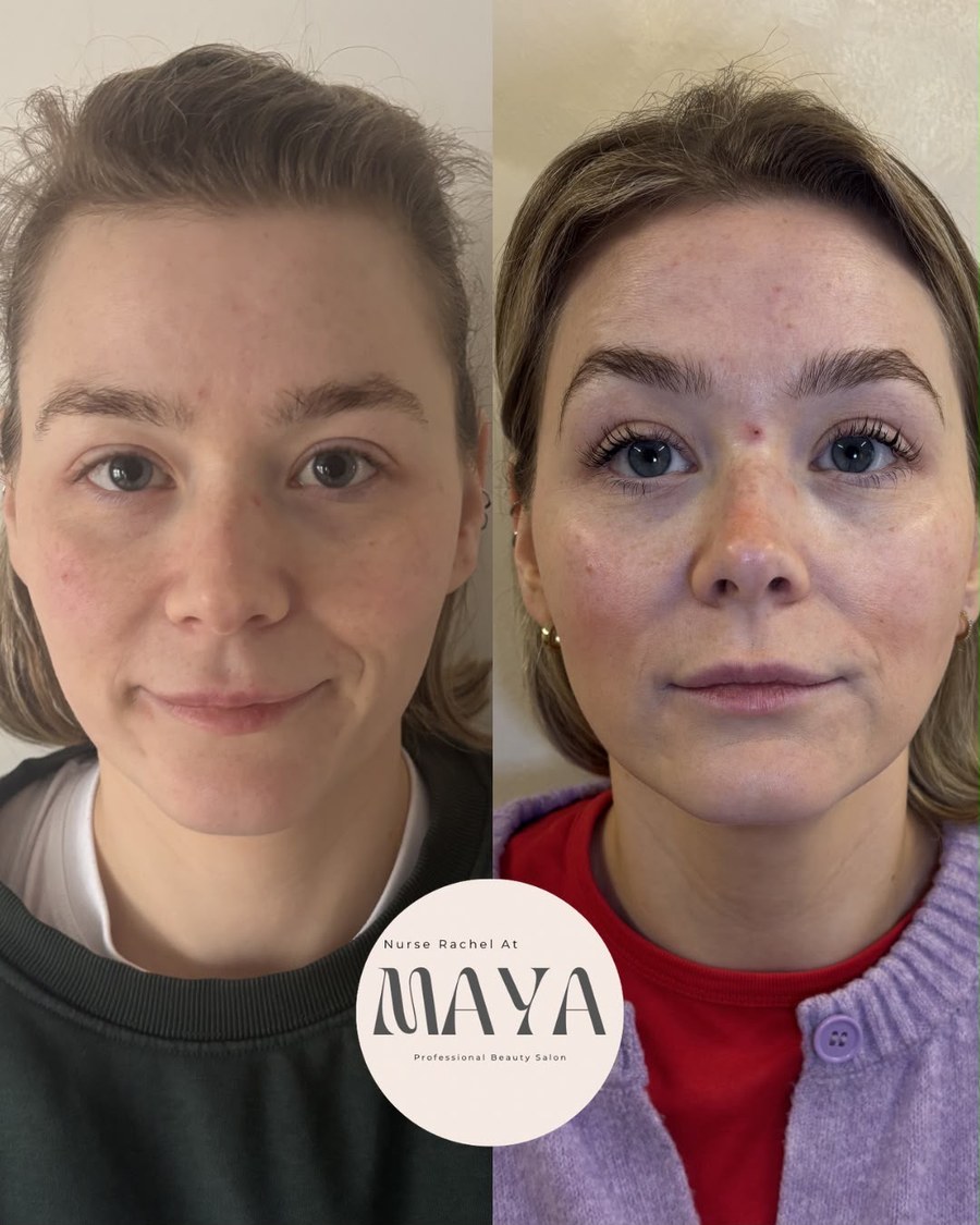 Before and after front view of a client's face