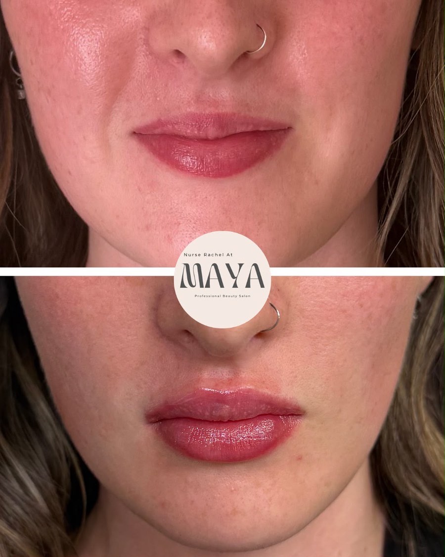 Before and after close-up of lip treatment