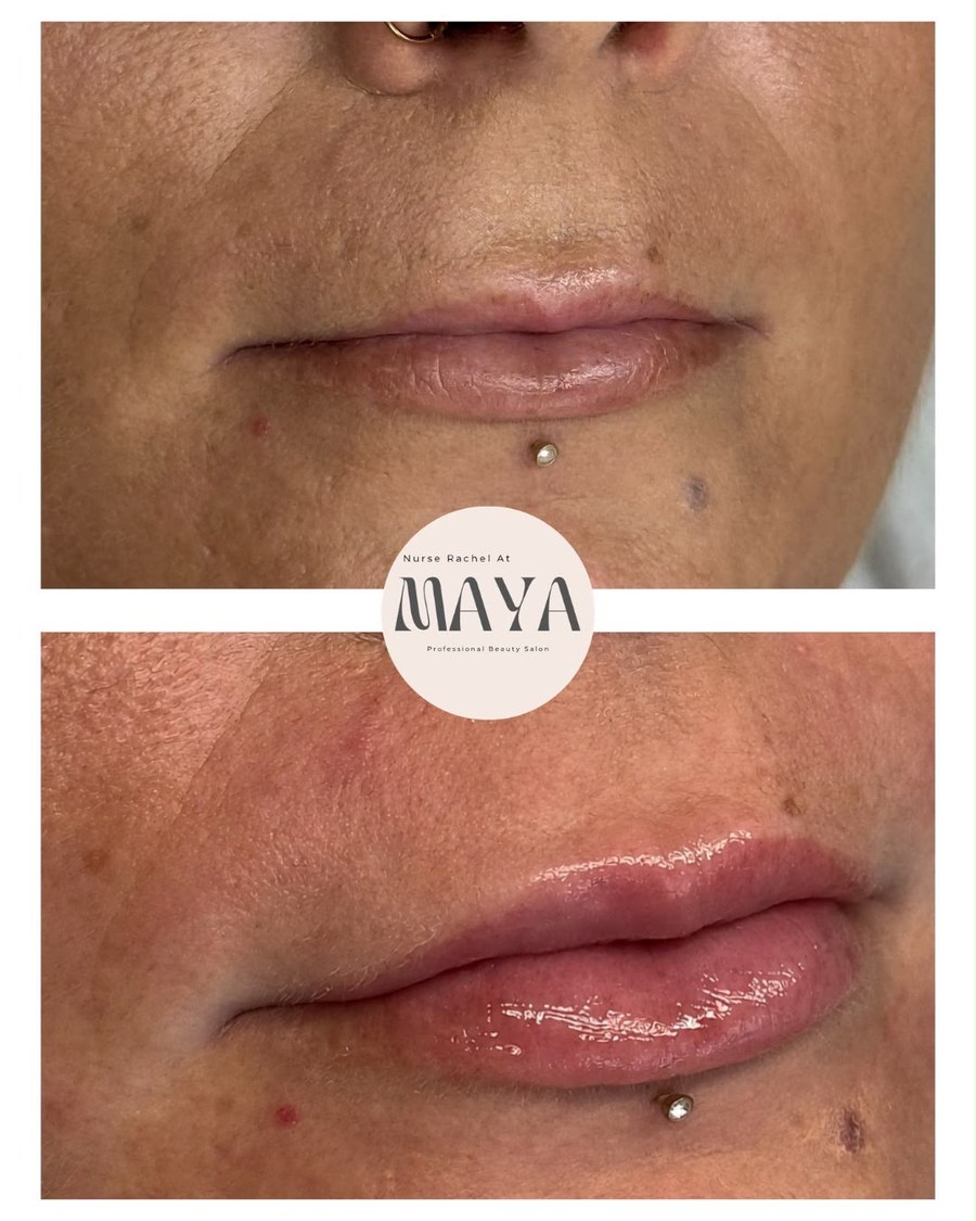 Before and after close-up of lips
