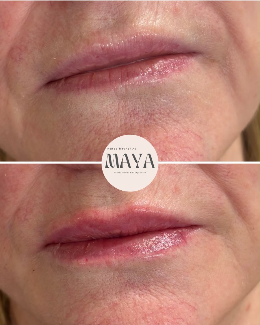 Before and after close-up of lips