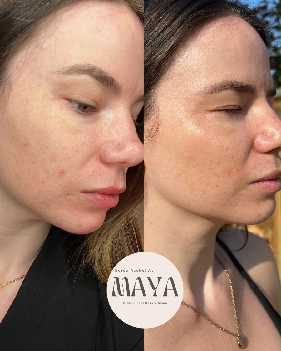 Before and after side view of skin